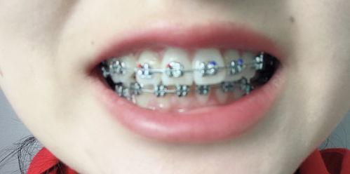 成人怎样纠正牙齿视频,视频教程揭秘矫正过程