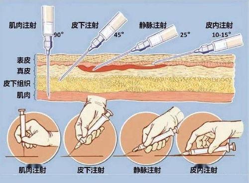 成人肌肉注射教学视频